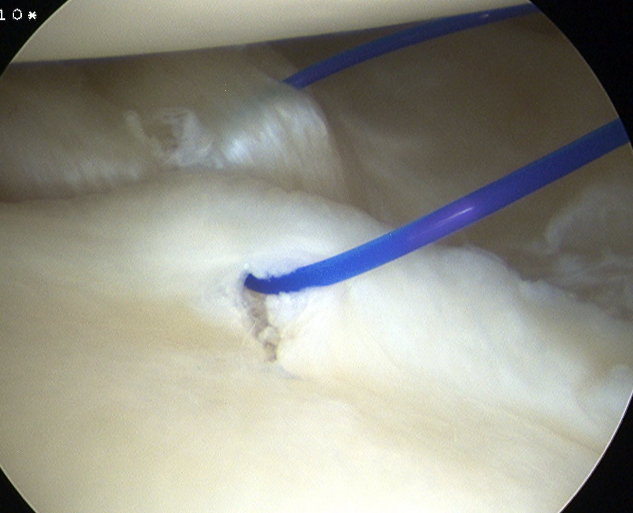 MDI Anterior Capsular Plication 2